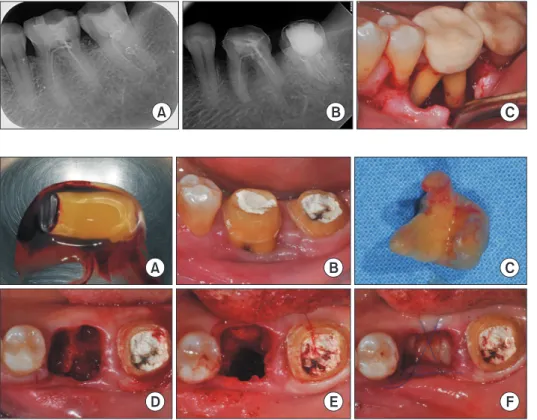 Fig. 1. (A) Periapical image 2 months  before first visit. (B) Periapical image  at first visit