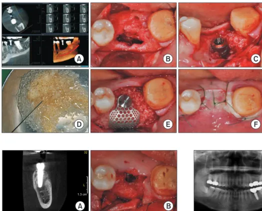 Fig. 4. Cone-beam computed tomography image (A) and occlusal 
