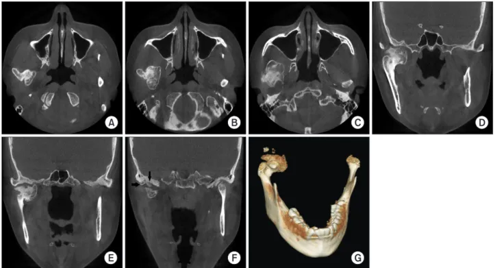 Fig. 4. Cone-beam computed tomography (CT); (A–C) Axial scans, (D–F) Coronal scans, and (G) 3D image