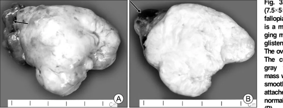 Fig.  3.  Left  ovarian  mass  (7.5×5×4  cm)  with  attached  fallopian tube (arrow) (A)