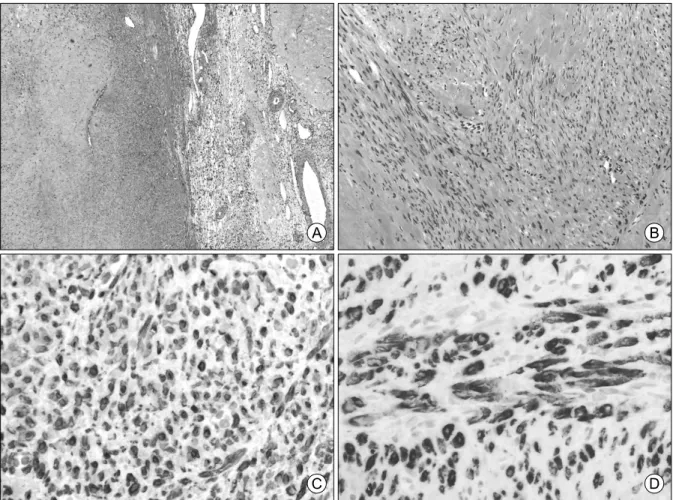 Fig.  4.  Microscopic  findings;  (A)  On  low  power  field,  a  well-demarcated  spindle  cell  tumor  is  identified  (left)