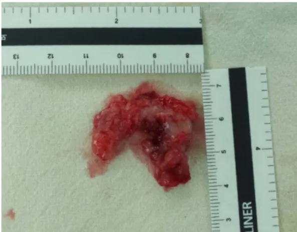 Fig. 1. Ill-defined radiolucency between #23 and #26 was shown in panoramic view.