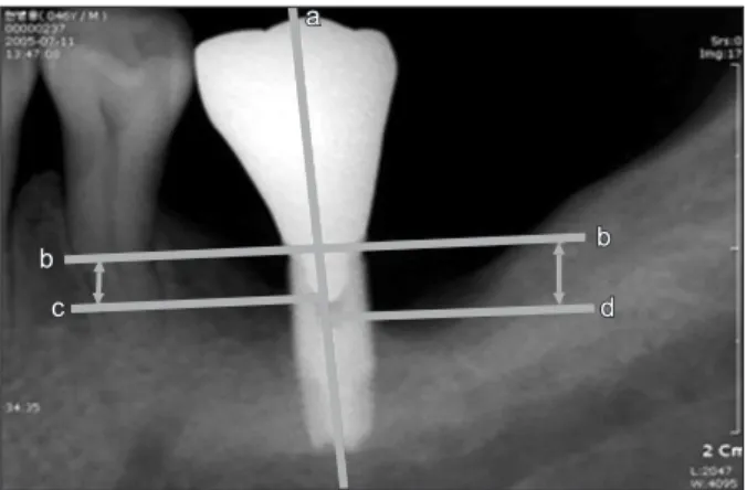 Fig. 1. Reference points for the measurements of marginal bone  level. Following is the reference lines: line a Implant longitudinal  axis; line b Implant shoulder line: vertical line to a, and at the most  coronal level of the implant shoulder; line c the