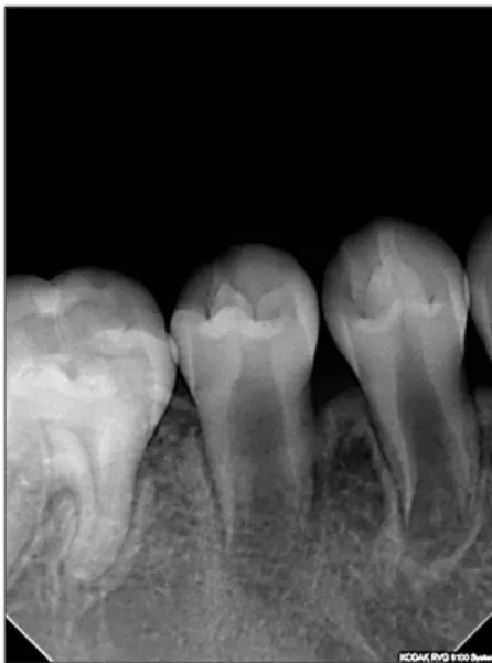 Fig. 1. Panoramic radiograph of #45 with periapical lesion at initial  visit.
