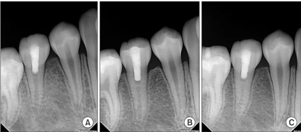 Fig. 9. Three weeks after double antibiotics, coronal discoloration  was observed.