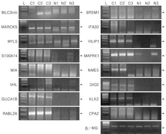 Fig.  2.  RT-PCR  revealed  that  the  expression  of  MLC3nm,  MACMARCKS,  MYL2,  S100A14,  MIA,  VHL,  GUCA1B,  RABL2A, BRMS1, IFI30, VILIP1, MAPRE1, NME5, DIO2, KLK 2, and CPA2 was observed mostly in epithelial ovarian  cancer tissues, but MACMARKS, GYC
