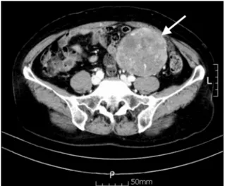 Fig. 1. Computed tomography showed a left-sided bulky  heterogenous  mass  displacing  adjacent  organs  (white  arrow).