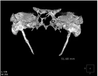 Fig. 3. The resected styloid process. This picture is published with the  patient’s consent