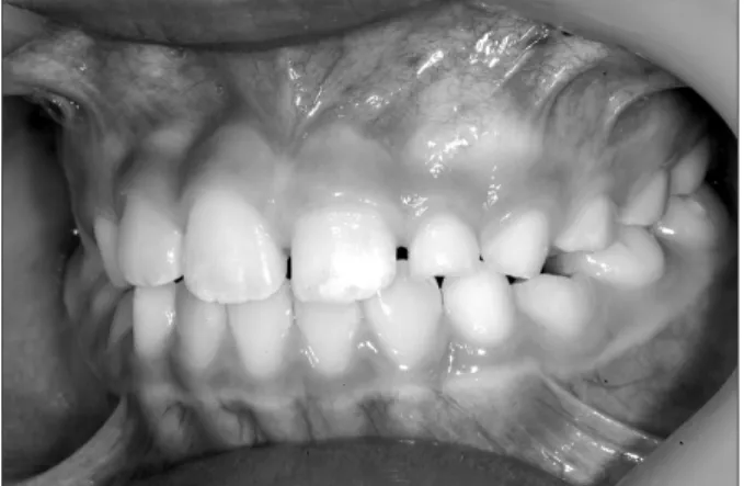 Fig. 3. Lingual button was applied on the left maxillary lateral incisor  and flap was sutured.