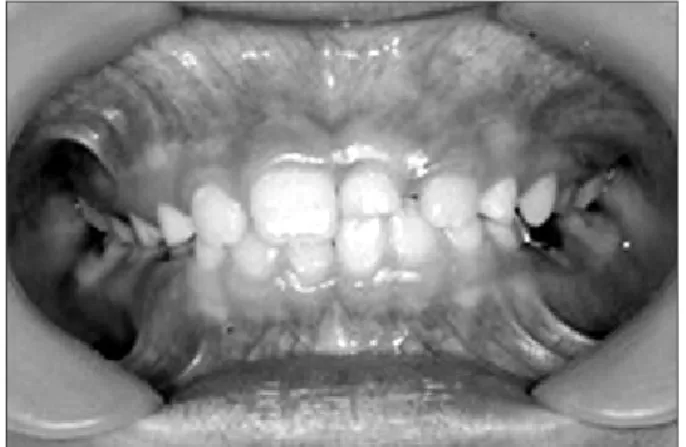 Fig. 7. Pre-treatment panoramic view. Multiple toothlets preventing  the eruption of the left maxillary central incisor.