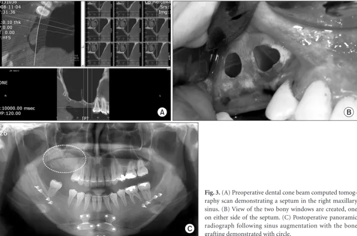 Fig. 3. (A) Preoperative dental cone beam computed tomog- tomog-raphy scan demonstrating a septum in the right maxillary  sinus