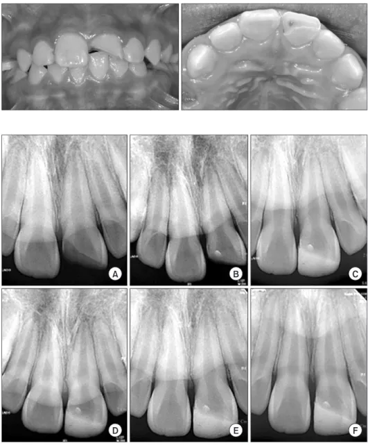 Fig. 1. Case 1. Intra-oral photograph at  initial visit. 