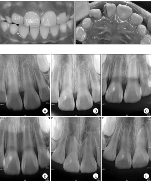 Fig. 3. Case 2. Intra-oral photograph at  initial visit. 