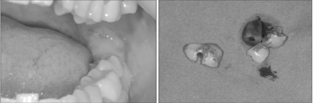 Fig. 1. Initial panoramic radiography. There were periapical lesion  associated with #36.