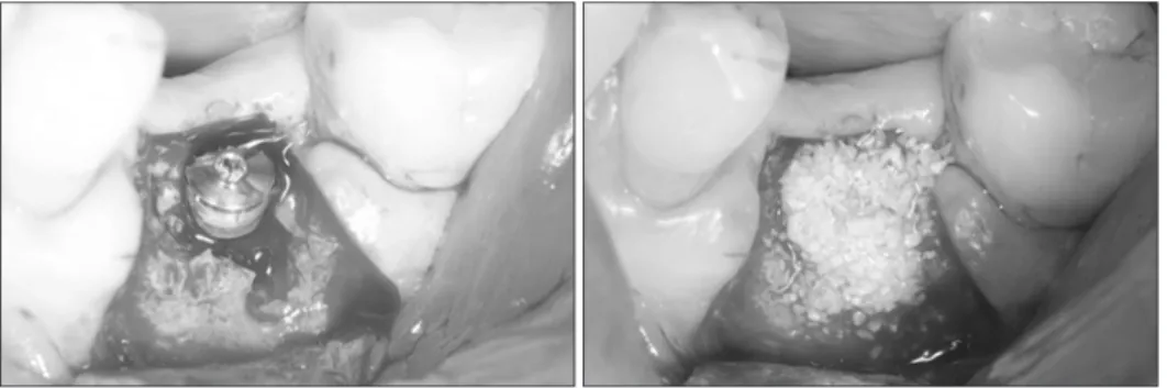 Fig. 5. #36 implant placement and  guided bone regeneration on buccal  bony defect.