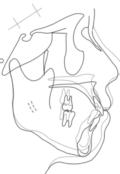 Fig. 4. Cephalometric superimposition: countinous line, initia; dot- dot-ted line, end of treatment