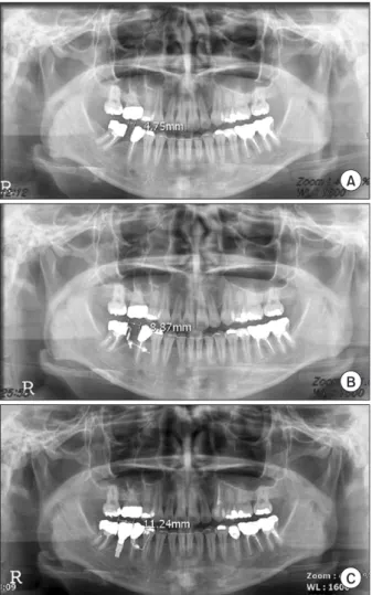 Fig. 3. Initial teeth state. Elongation of left maxillary second premo- premo-lar-second molar was detected.