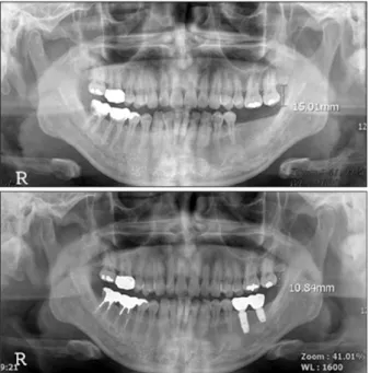 Fig. 6. Space was gained for implant  placement on left mandibular fi rst  mo-lar area.