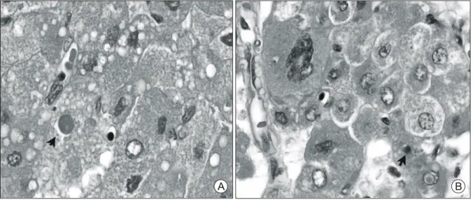 Fig. 4. Serum alphafetoprotein level corresponding to  each chemotherapy. *Post staging laparotomy,  †  post-operative adjuvant chemotherapy,  ‡ palliative  opera-tion:  palliative omentectomy and lymph node biopsy.