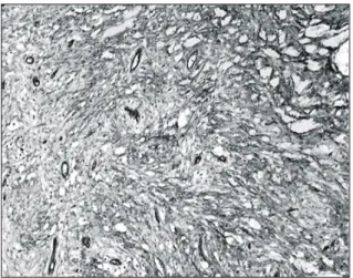 Fig. 2. Benign-looking spindle cells show a short  storiform arrangement  (Hematoxilin &amp; Eosin, ×100).