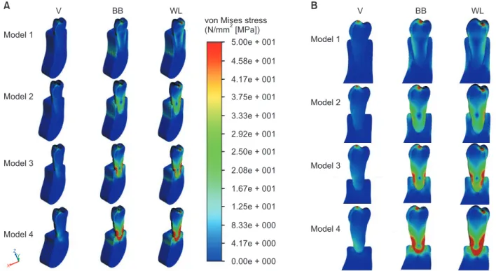 Fig. 5. Comparison of peak von Mises  stress (VMS) values in cervical enamel  region in 4 models under vertical and  2 non-axial (B, WL) loadings