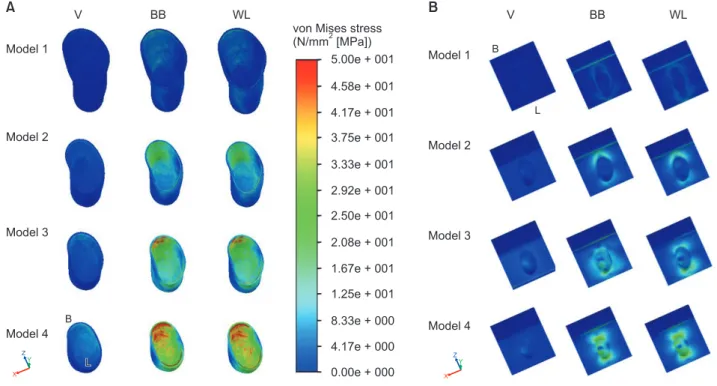 Fig. 7. von Mises stress profile in periodontal ligament (A) and alveolar bone components (B) from the frontal view in 4 models under axial (V)  and 2 non-axial (BB, WL) loadings