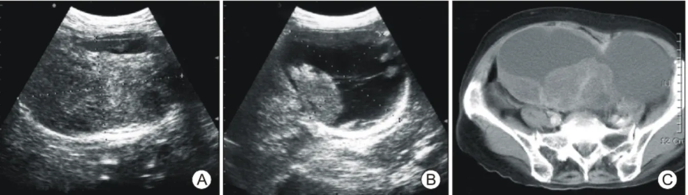 Fig. 1. Transvaginal ultrasonography is showing 13.2×8.2 cm sized well-defined large mass with mixed echogenicity at Lt