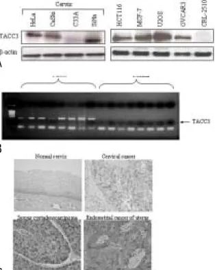 Fig. 4. TACC3 expression in various cancer cell lines, cervical and ovarian tumor tissues