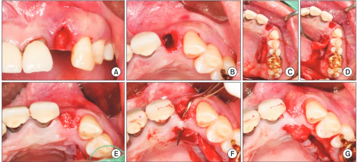 Fig. 4. Surgical process of patient 1. (A) Buccal intraoral view of #22 after atraumatic extraction using periotome