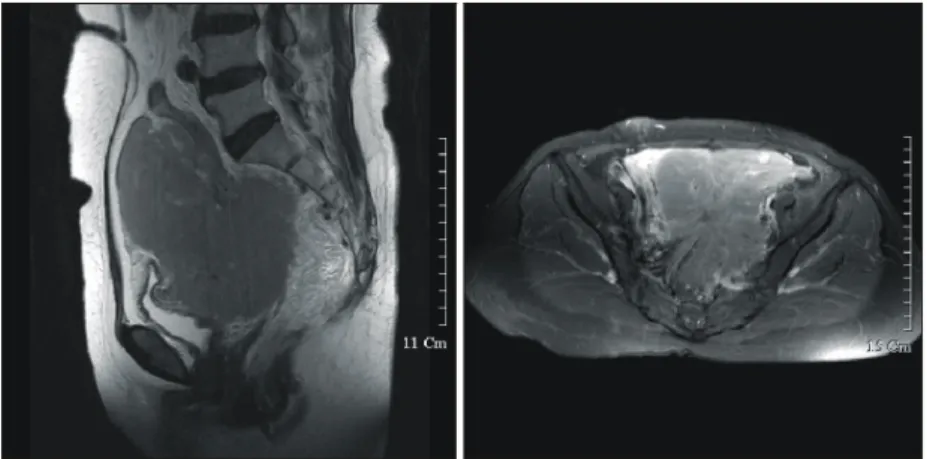 Fig. 1. Huge lobulated mass le- le-sion is measured 11×12×11 cm   size in left pelvis
