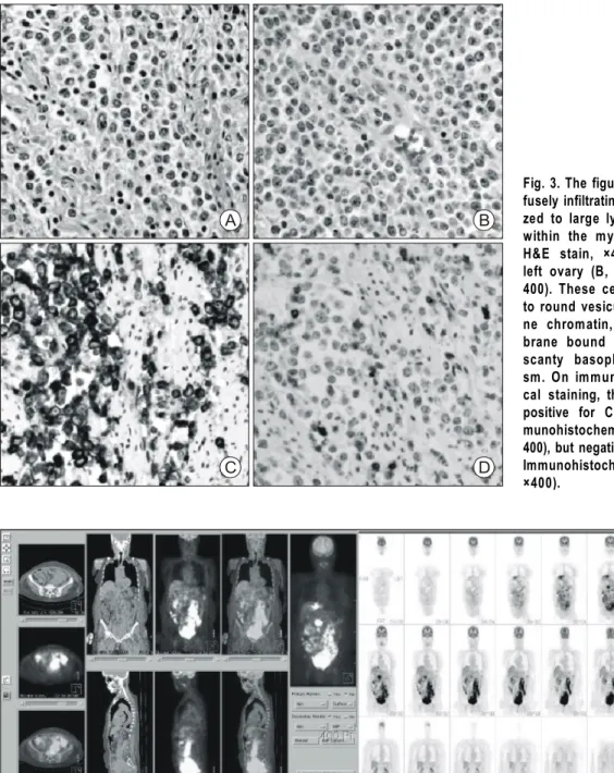 Fig. 3. The figure reveals dif- dif-fusely infiltrating medium-  si-zed to large lymphoid cells  within the myometrium (A,  H&amp;E stain, ×400) and the  left ovary (B, H&amp;E stain, × 400)