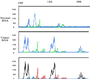 Fig. 1. Examples showing high frequency microsatellite instability (MSI-H) in endometrioid endometrial  adenocar-cinoma