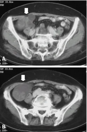 Fig. 2. A) Contrast material-enhanced CT scan shows a tubular mass of low attenuation, representing hydrosalphinx in the right lower quadrant