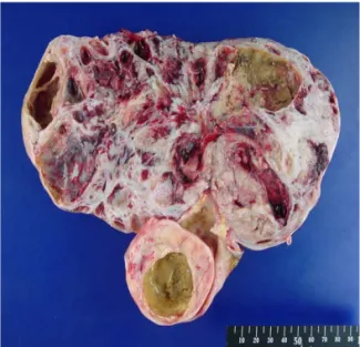 Fig. 2. Cross section of primary insular carcinoid associated with  ovarian  mature  cystic  teratoma.