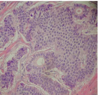 Fig. 3. Insular carcinoid composed of solid tumor nest and discrete  acini  (H&amp;E  ×200).