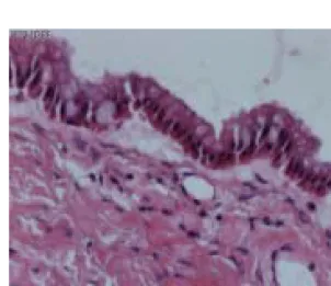 Fig.  4.  The  microscopic  finding  showing  the  cyst  with  long  columnar  epithelial  cells  containing  mucin  of  which  nuclei  are  arrayed  in  a  single  or  two  layers(H&amp;E,  ×400).