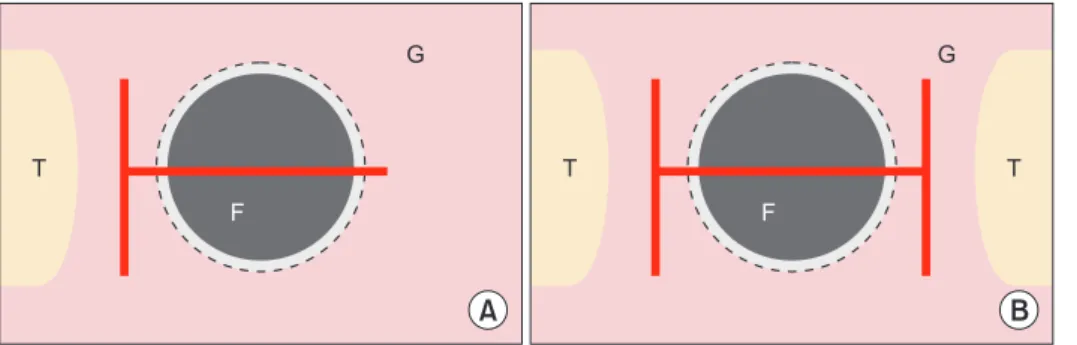 Fig. 2. Modification of minimalized inci- inci-sion design. (A) Two-inciinci-sion design