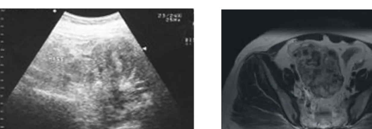 Fig.  1.  Ultrasound  shows  right  ovarian  mass  with  multiple  echogenic  components  suggesting  internal  extensive  hemorrhage  (A)