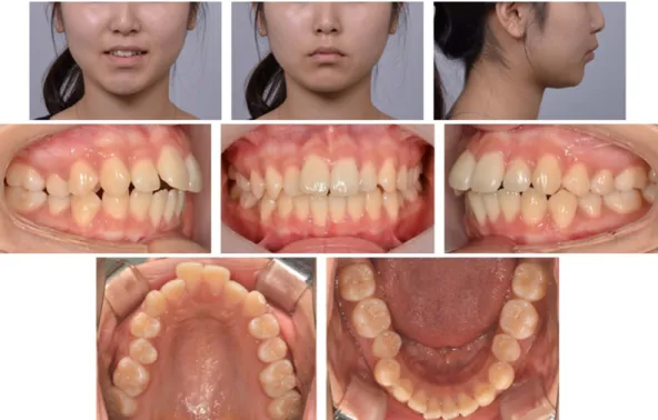 Fig. 2. Pretreatment lateral cephalometric radiograph and panoramic radiograph.