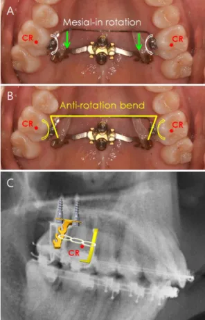 Fig. 4. LIM plate system for maxillary molar distalization.