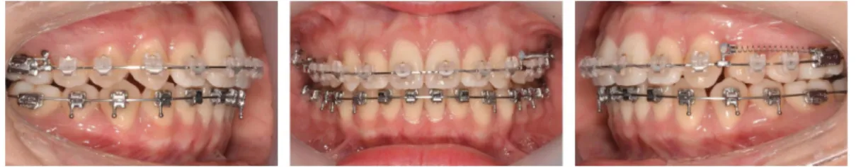 Fig. 12. Intraoral photograph at 12 months of treatment. Interprox- Interprox-imal reproximation was performed on maxillary anteriors (white arrows).