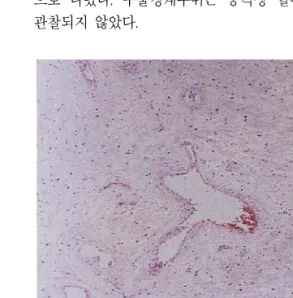 Fig.  2.  Aggressive  angiomyxoma  is  paucicellular  with  bland  spindle  shaped  cells  set  in  a  copious  myxoid  matrix