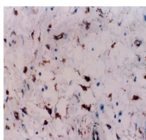 Fig.  3.  Diffuse  CD34  immunoreactivity  in  spindle  and  stellated-shaped  tumor  cells  (×400).