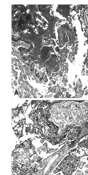 Fig.  1.  Section  of  choriocarcinoma  (×100).