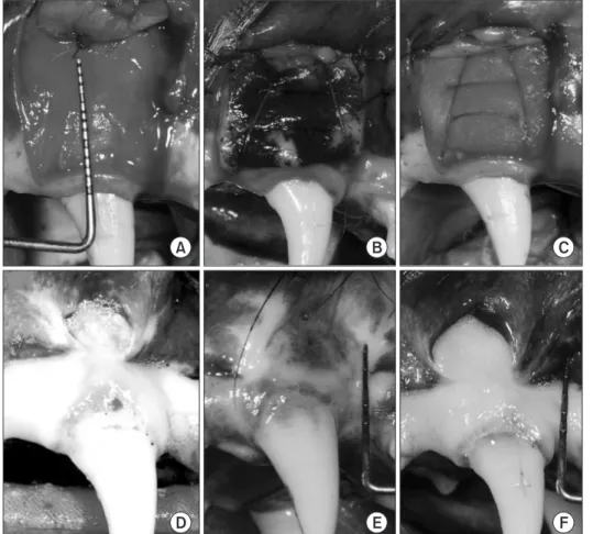 Fig. 1. Clinical procedure. (A) Apically  repositioned flap (APF) was done. 