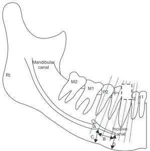 Fig. 1. Diagram showing the parameters of the mandibular incisive  canal. The each broken lines indicate the long axis of the tooth and  interdental area