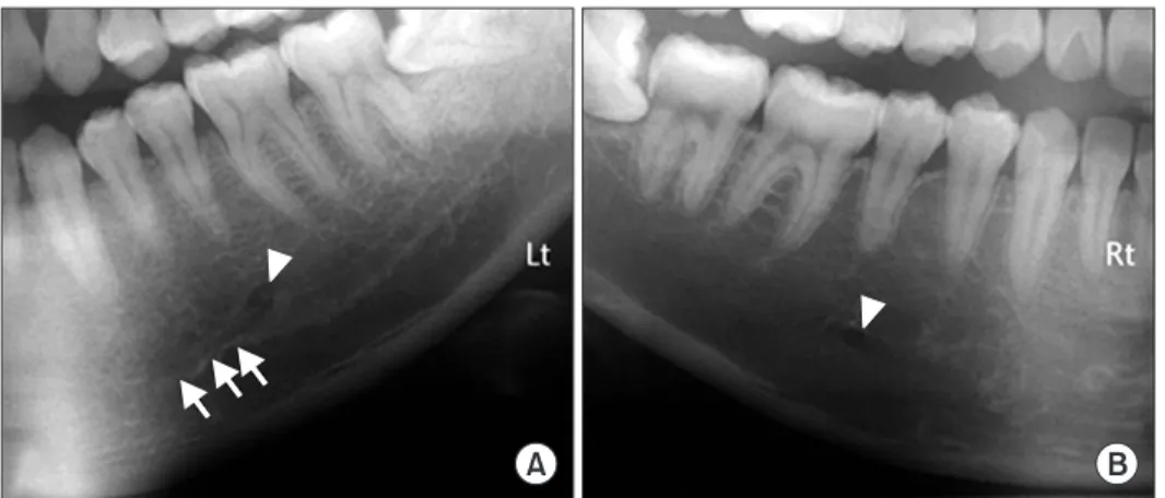 Table 1. Origin and End Points of the Mandibular Incisive Canal according to the Tooth Level