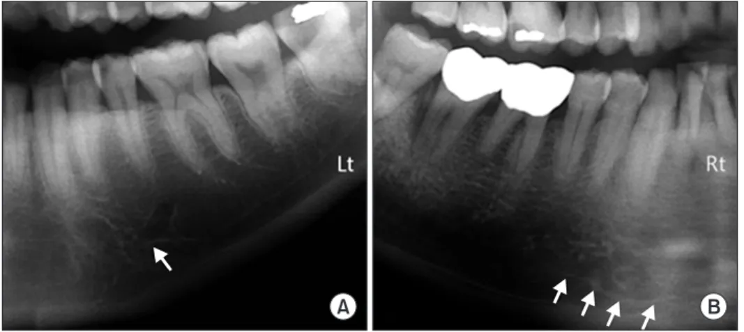 Table 2. Diameter and Location of the Mandibular Incisive Canal Based on Gender
