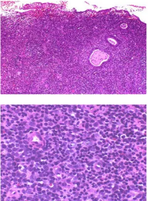 Fig. 4. Positive on CD79a phenotypically in immunos- immunos-taining of endometrium (x200).