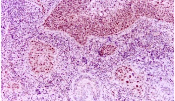 Fig 3. Microvessels in invasive squamous cell carcinoma identified by immunochemical staining for factor Ⅷ 